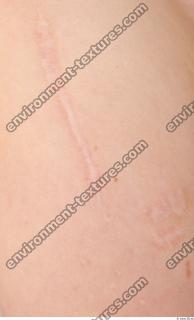 photo texture of scarred skin 0002